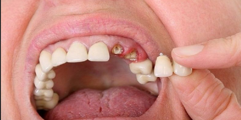 Nằm mơ thấy rụng răng hàm trên